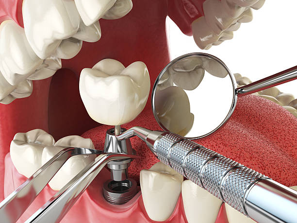 Best Emergency Dentist for Lost Fillings or Crowns in Tallapoosa, GA